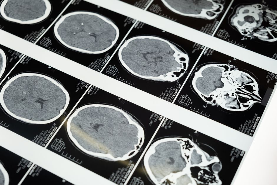Clichés d'IRM cérébrale disposés sur un négatoscope